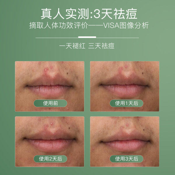 凈痘清顏舒緩精華液